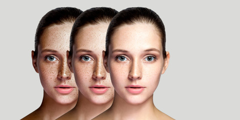 Step by step concept of healing and removing freckles. Closeup portrait of beautiful brunette woman...