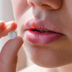 Part of a young woman's face with a virus herpes simplex on lips, treatment with pills