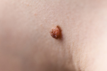 Unrecognizable person having dark fibroma, dermatology problem on skin. Close up of papilloma...
