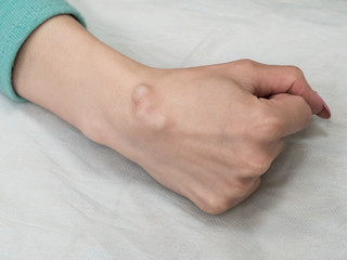 Big cyst (hygroma), fluid filled lump associated with a joint