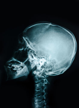 Film x-ray skull.