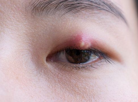 Close up of Asian young woman with brown eye with stye infection. Eyelid abscess, hordeolum in medical health, disease and treatment concept.