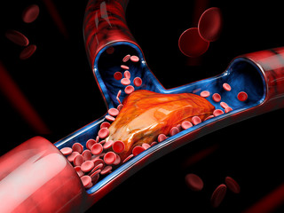 3d Illustration of Deep Vein Thrombosis or Blood Clots. Embolism - obrazy, fototapety, plakaty