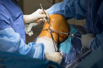 Knee Surgery