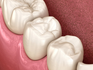 Premolar tooth restoration with filling. Medically accurate tooth 3D illustration.