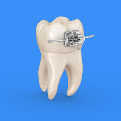 Tooth and metal braces. 3D illustration concept
