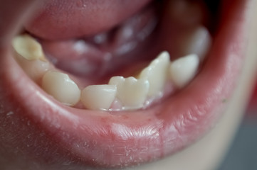 Permanent and milk teeth on a child. Gums are swollen. on some teeth there is some dental plaque.