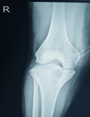 X-ray Knee showing Localized mild osteosclerosis plus 4.5 cm lytic lesion at irhgt upper tibia. No periosteal reaction is seen. Bone tumor is suspected. Normal right knee joint