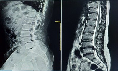 X-ray image Two views general x-ray and MRI lumbar spine showing Herniated nucleus pulposus of...