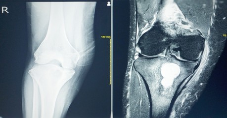 MRI OF THE RIGHT KNEE History: Right knee pain, R/O TB arthritis or bone tumor.Localized mild osteosclerosis plus 4.5 cm lytic lesion at irhgt upper tibia. No periosteal reaction is seen. Bone tumor.