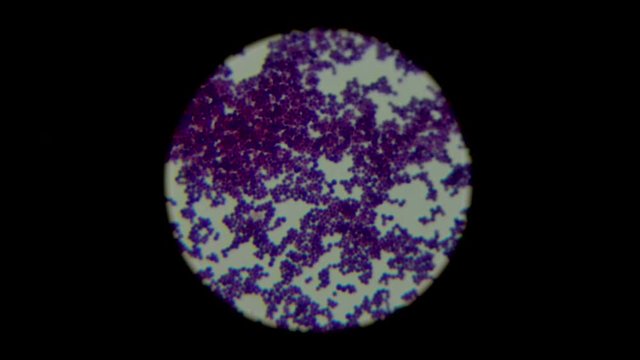 Smear of human biological sample culture Gram's stained with gram positive staphylococcus in cluster with binary fission bacteria under light microscope