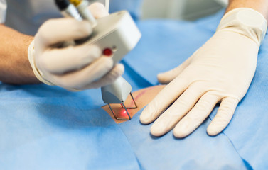 The doctor makes a laser correction of the scar on the skin