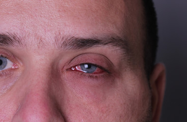 Close-up of conjunctivitis red eye