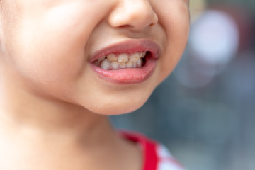 Asian little girl has decayed baby teeth.