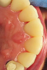 Healthy teeth in humans. Removal of plaque in the dental clinic. Treatment of dental caries at the...