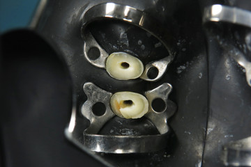 Remove the old fillings in the tooth. Treatment of bad teeth in the dental clinic. Restoration of...