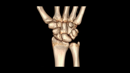 CT SCAN 3D of wrist joint