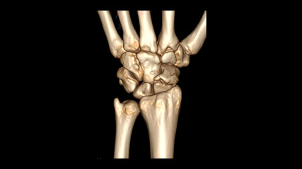 CT SCAN 3D of wrist joint