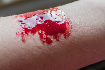Blut Arm Selbstverletzung Ritzen