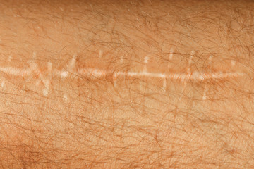 scar on the leg. Human leg with old postoperative scar of hip joint surgery.  Detail of skin with deep chirurgical cut. Health care in hospital. Hipster filter.