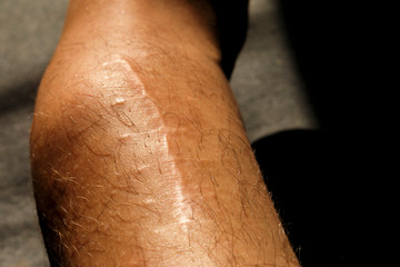 postoperative scar on a crippled leg with dyschondroplasia. postoperative scar on the shin. scar on...