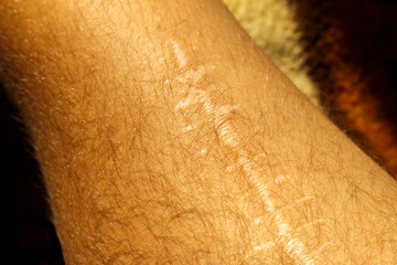 Scars on the body. arm skin after surgery and accident. Scar on the broken arm.