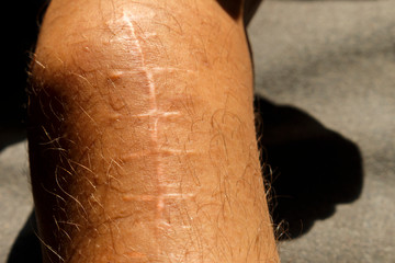 Scars on the body. arm skin after surgery and accident. Scar on the broken arm with a lot of black...