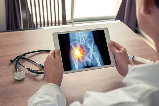 Doctor holding a digital tablet with x-ray of hips and pain on the left