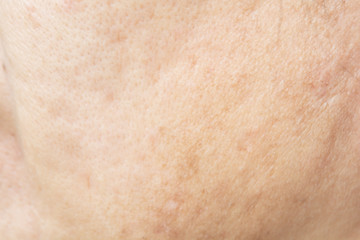Naklejka premium Pores on the face in women