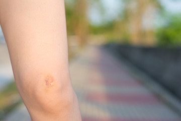Bright bruise damage on knee of young woman. A girl rubs her fingers with a curative ointment in a...