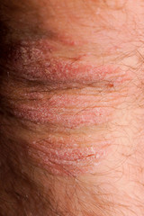 Fototapeta premium Psoriasis dry red and white irritation on the skin closeup.