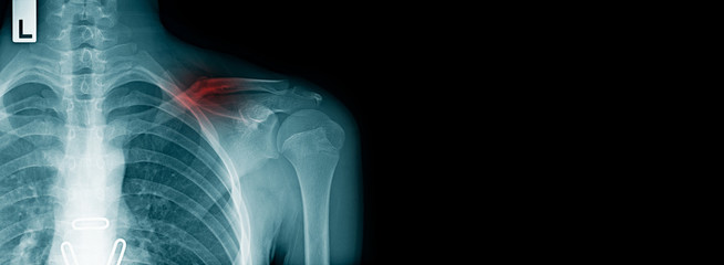 x-ray image clavicle fracture