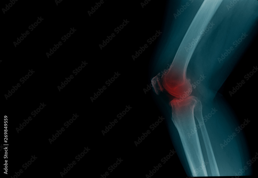 Wall mural knee joint x-ray image