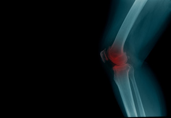 knee joint x-ray image