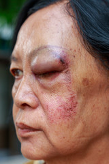 Obraz premium Elderly injury to the eyelid