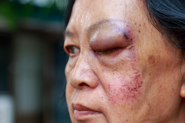 Elderly injury to the eyelid