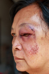 Elderly injury to the eyelid