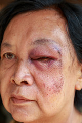 Elderly injury to the eyelid