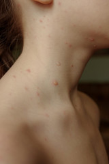 Chickenpox virus, chickenpox or measles. Close-up of a naked body of a child with chickenpox acne. Inflammation of the skin. Healthcare concept. Shingles