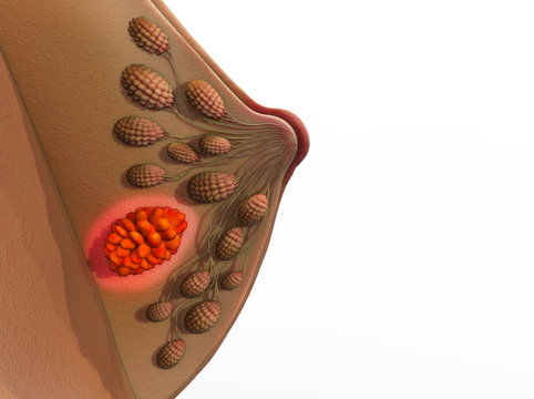 Breast cancer 3D Render