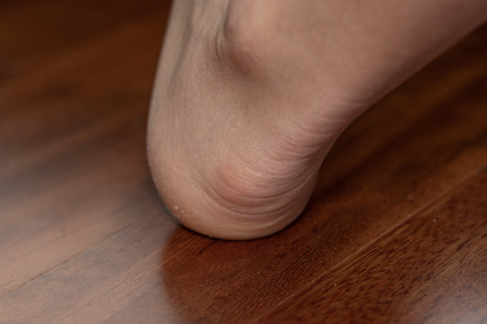 Heel affected by bursitis