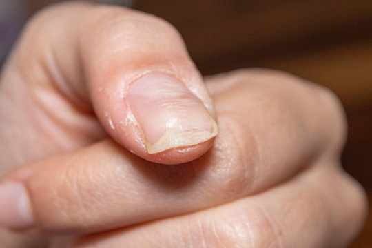 Thumb nail affected by deformity, medical condition