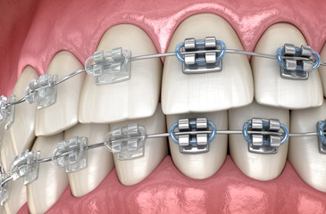 Teeth with metal and Clear braces. Medically accurate dental 3D illustration