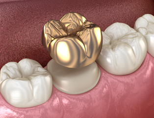 Golden crown molar tooth assembly process. Medically accurate 3D illustration of human teeth treatment