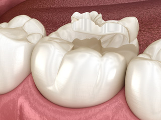 Inlay ceramic crown fixation over tooth. Medically accurate 3D illustration of human teeth treatment