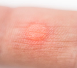 Red wet corn dropsy on the finger on the hand, macro, callus on the skin, inflammation