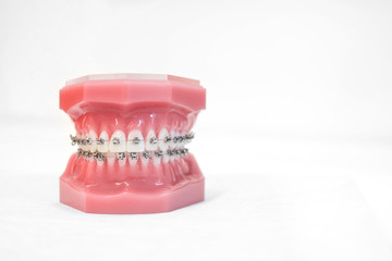 braces on teeth model  of orthodontic bracket or brace