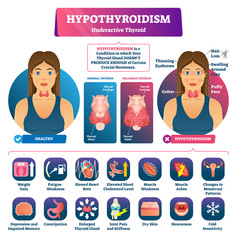 Hypothyroidism vector illustration. Labeled underactive thyroid explanation
