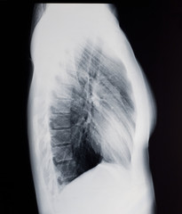 X-ray of the woman's lungs, side view.