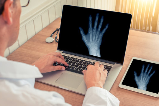 Doctor watching a laptop with x-ray of a right hand in a medical office. Osteoarthritis concept